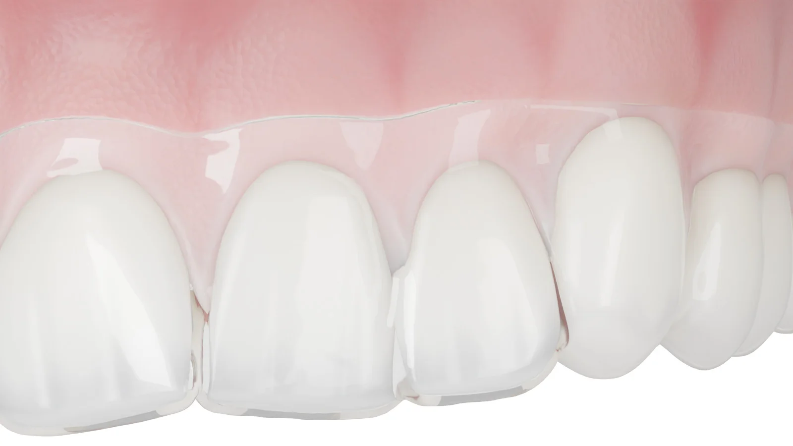 Render 3D: el borde recto del alineador Sorridi supera el margen gingival